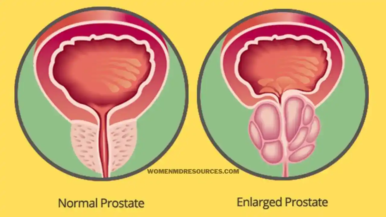 Enlarged Prostate