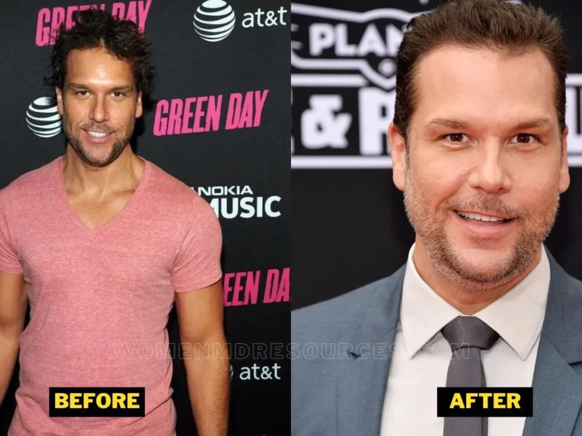 Dane cook before and after plastic surgery