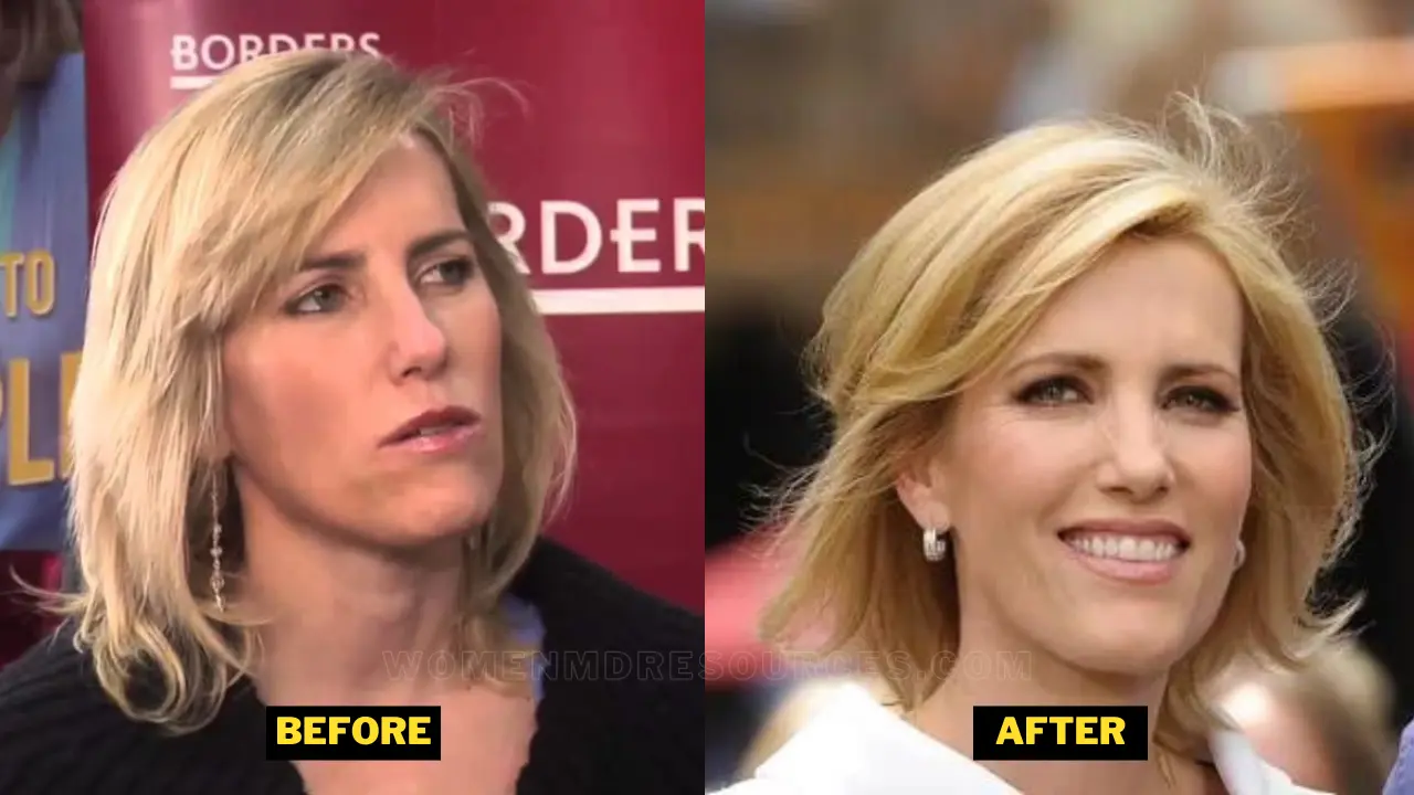 Laura Ingraham Before After Pictures