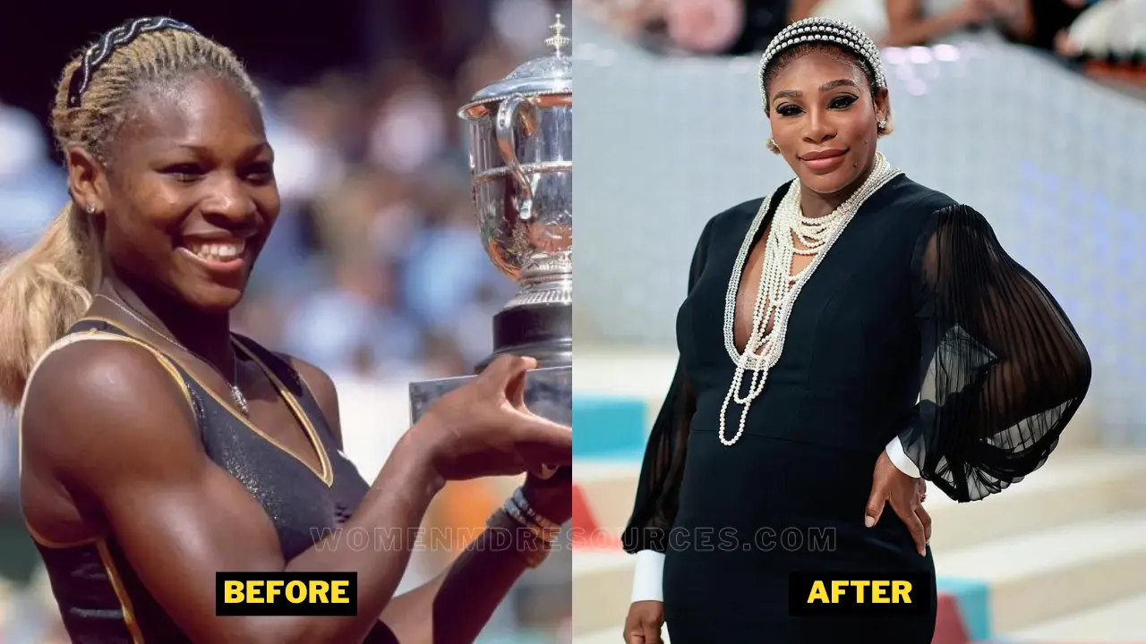 Serena Williams Lip Fillers