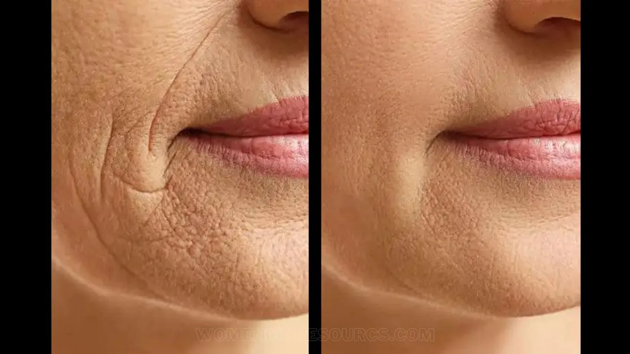 Botox For Marionette Lines Before After
