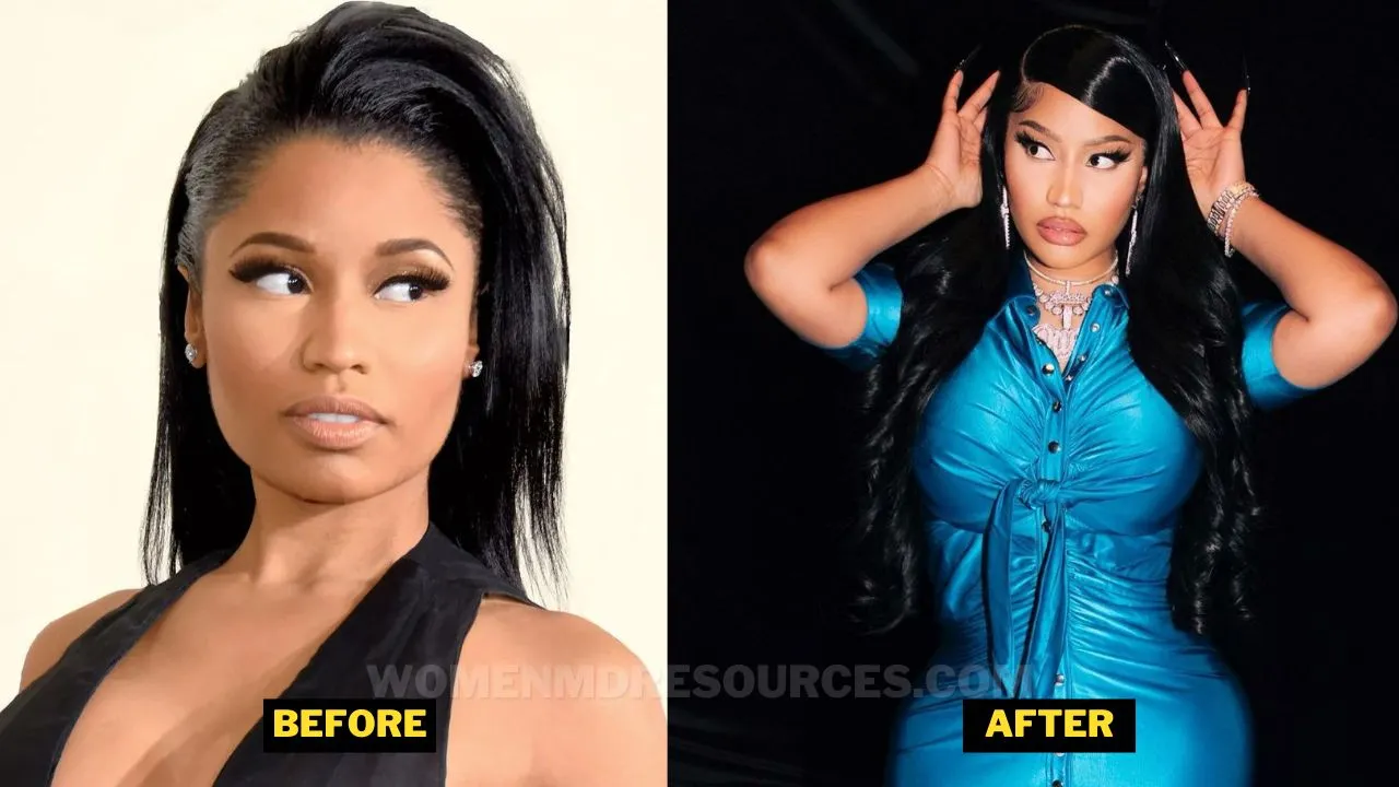 Nicki Minaj Before After